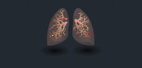 肺癌是我國(guó)惡性腫瘤發(fā)生和死亡的第一位腫瘤