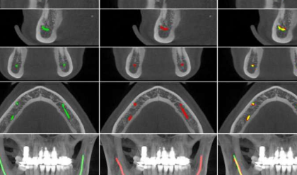 人工智能使牙醫(yī)的工作更加輕松 新模型有助于對下頜管進(jìn)行定位