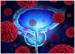 建立新的聯(lián)合療法對(duì)前列腺癌安全有效