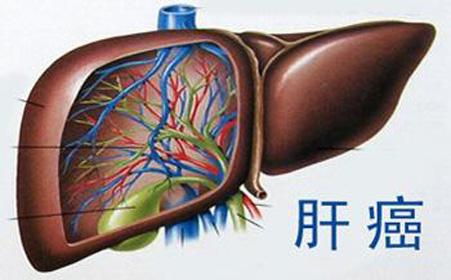 基因與最常見的肝癌有關(guān)