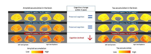 tau在大腦中的早期積累可預(yù)測阿爾茨海默病的記憶力下降