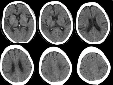 研究發(fā)現(xiàn) MRI 上的腦部病變與多年踢足球有關(guān)