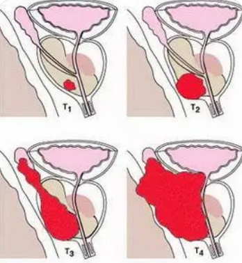 前列腺癌類器官為精準治療開辟了道路