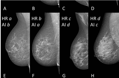 AI 提供準確的乳房密度分類