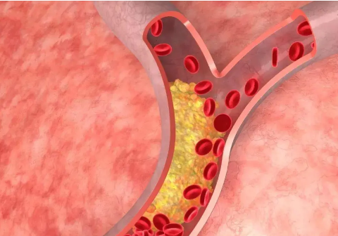 高血脂使細胞分擔(dān)壓力