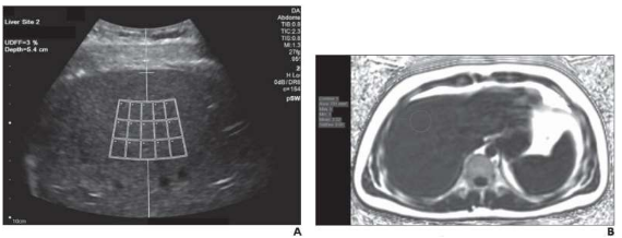 超聲檢測肝臟脂肪與 MRI 質(zhì)子密度脂肪分?jǐn)?shù)