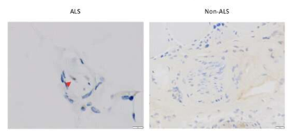 生物標(biāo)志物的肌肉活檢測(cè)試可能導(dǎo)致早期診斷 ALS