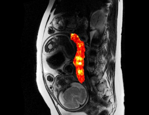 研究人員開發(fā)了新的成像方法來檢測(cè)妊娠早期的并發(fā)癥