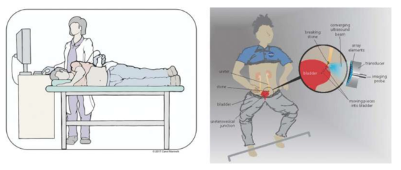 一項新的研究發(fā)現(xiàn)在患者清醒時超聲可用于移動重新定位或分解腎結(jié)石