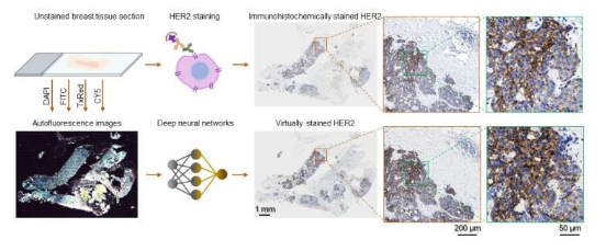 基于深度學習的組織虛擬染色有助于快速評估乳腺癌生物標志物