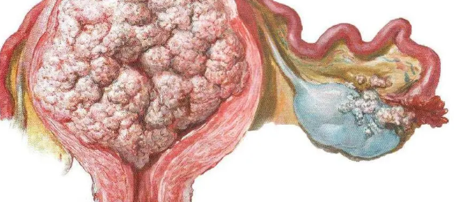 研究確定了治療子宮內(nèi)膜癌的新治療策略