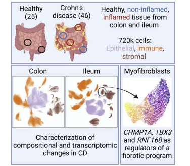 克羅恩病的單細(xì)胞分析揭示了腸道炎癥的詳細(xì)情況