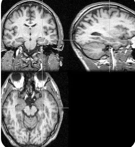 開發(fā)出人類海馬 CA1 區(qū)的新高分辨率模型