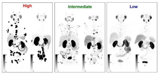 新開發(fā)的 PSG 評分改進了 PSMA 放射性藥物治療的患者選擇