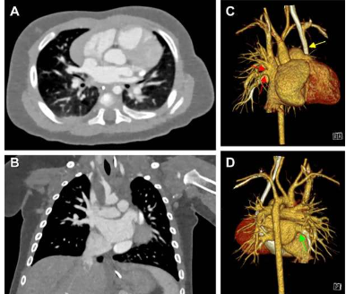 光子計數(shù) CT 為患有心臟缺陷的嬰兒提供卓越的成像