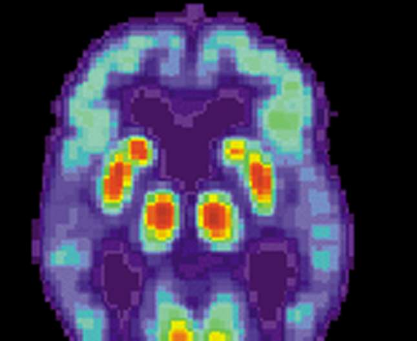 人工智能工具有望更快 更準(zhǔn)確地診斷阿爾茨海默病