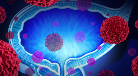 研究人員揭示了侵襲性前列腺癌與TP53突變之間的聯(lián)系