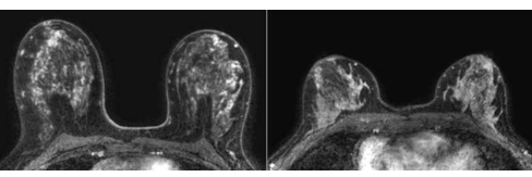 MRI 增強增強有助于表明乳房致密女性的癌癥風險