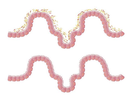 研究揭示腸道微生物群與 IBD 治療反應(yīng)之間的聯(lián)系