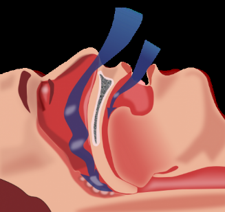 睡眠呼吸暫停與慢性腎病風險增加有關