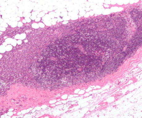 科學家開創(chuàng)了乳腺癌治療的突破性方法