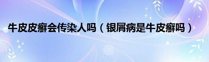 牛皮皮癬會傳染人嗎(銀屑病是牛皮癬嗎)