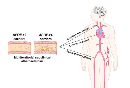與阿爾茨海默病相關(guān)的 APOE 基因變異也與亞臨床動脈粥樣硬化的發(fā)展有關(guān)