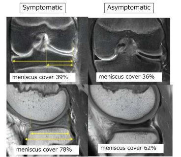 半月板的大小很重要：膝蓋疼痛的解釋