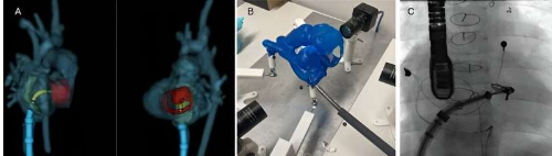 研究人員成功采用新方法治療患有常見心臟瓣膜疾病的兒科患者