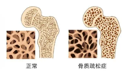 男性在骨質(zhì)疏松癥相關(guān)骨折后面臨更大的死亡風(fēng)險(xiǎn)