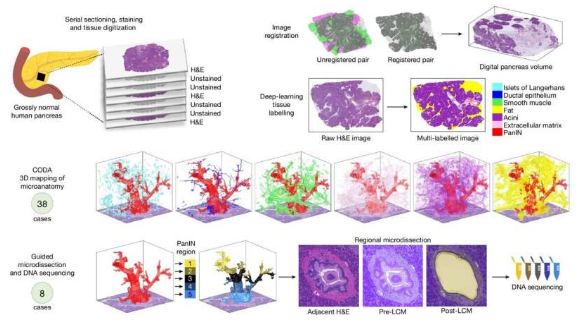 新的 3D 技術(shù)揭示胰腺癌前病變