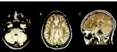 研究人員在癥狀出現(xiàn)之前就識別出患MS的高風險兒童