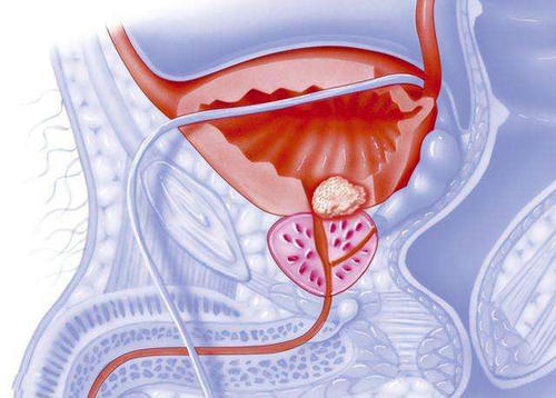 治療侵略性前列腺癌的新希望