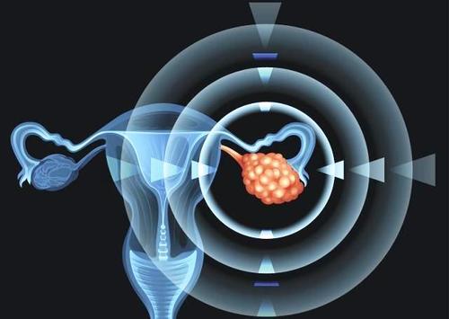 研究人員正在開(kāi)發(fā)一種基于抗體的方法來(lái)摧毀致命的卵巢癌