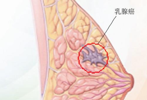 由遺傳主開關控制的乳腺癌