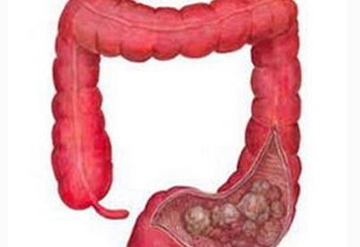 抑制蛋白質(zhì)可以減緩結(jié)腸癌和直腸癌的生長